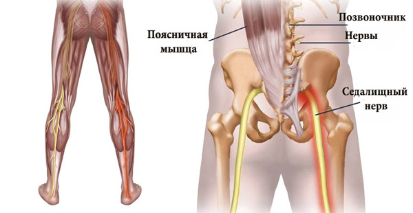Всё о воспалении седалищного нерва